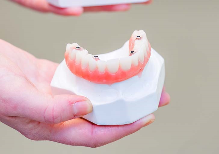 Upper Teeth Extraction For Dentures Champion NE 69023